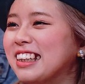 NiziU(ニジュー)リクの歯がない?!何故抜歯したのか、変化はあったのか徹底調査!